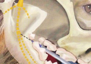 Inferior alveolar nerve block