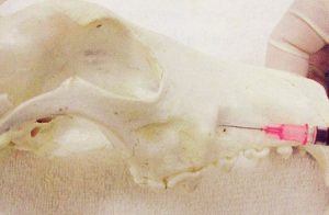 Infraorbital nerve block