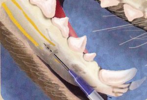 Mental nerve block