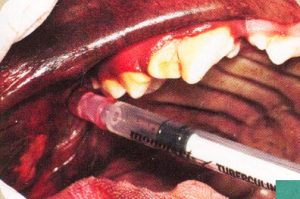 maxillary block 1