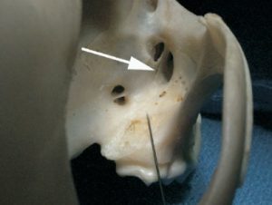 maxillary nerve block